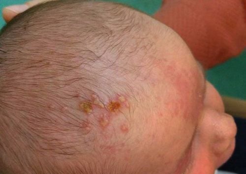 Causes of Pimples on Children's Heads