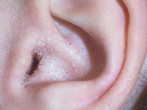 Ear Eczema in Children