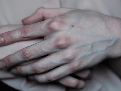 What causes swelling of blood vessels in the hand?