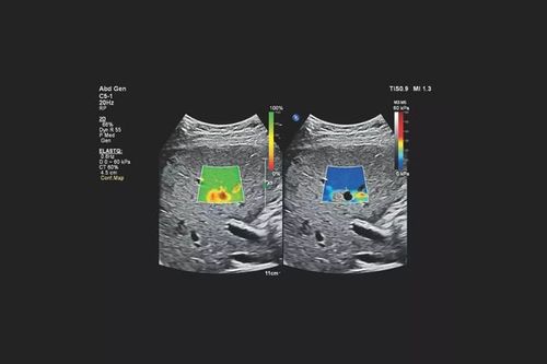 Application of Elastography Ultrasound in Musculoskeletal Medicine