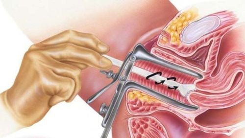 Xét nghiệm máu phát hiện ung thư cổ tử cung có lợi ích gì?
