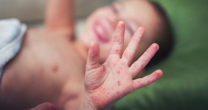 Bệnh Tay - Chân - Miệng ở trẻ: cách nhận biết và phòng tránh | Vinmec