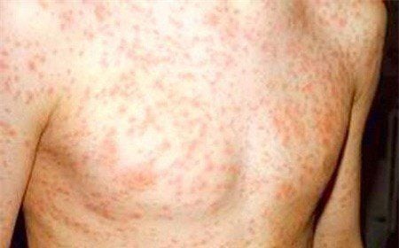 Adults can still contract measles