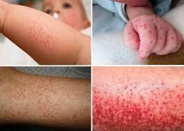 Subcutaneous bleeding spots often appear on the front of the lower legs, inner arms, abdomen, thighs, and flanks.