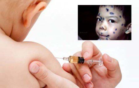 Tiêm vắc-xin phòng thuỷ đậu là biện pháp phòng bệnh hiệu quả nhất