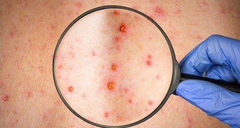 Triệu chứng của sởi bao gồm sốt cao từ 39 - 40 độ C, xuất hiện các nốt ban đỏ li ti,...
