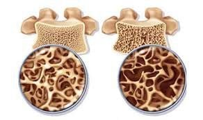 You need to check your bone density right after turning 30.

