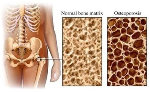 Calcium Deficiency Causes Osteoporosis