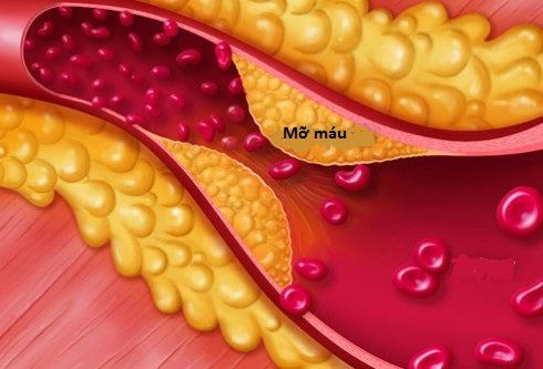 Triệu chứng của bệnh máu nhiễm mỡ Triệu chứng của bệnh máu nhiễm mỡ