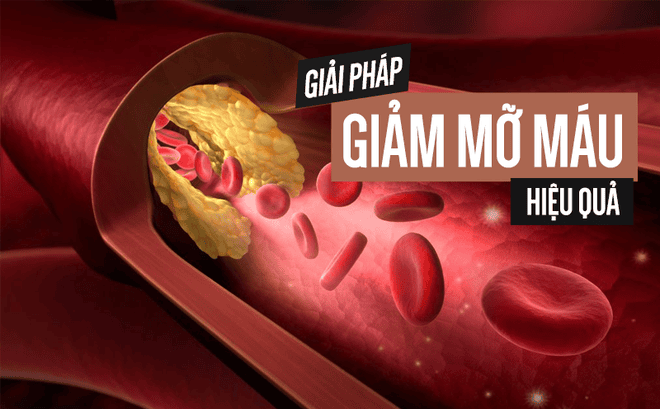 Mỡ máu cao: hai giảm ba tăng | Vinmec