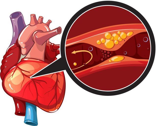 Đối tượng nào dễ mắc bệnh tim thiếu máu cục bộ? | Vinmec