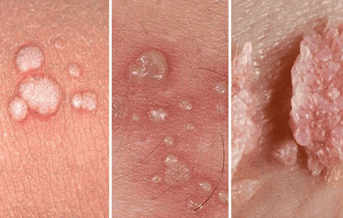 Hình ảnh trực quan về bệnh sùi mào gà