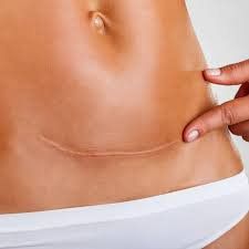 Horizontal incision is safer than the vertical incision method
