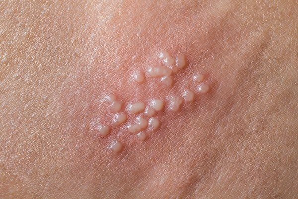 Mụn rộp sinh dục: Chớ coi thường! | Vinmec