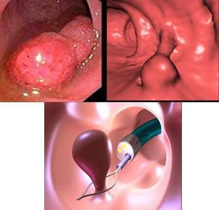 Uterine polyps