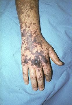 Tử ban do não mô cầu (Nguồn: uptodate 2019 Clinical manifestations of meningococcal infection)