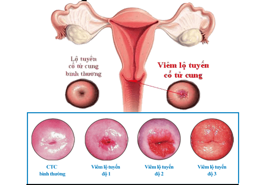 Cung tử cung tuyến tuyến viêm: Nguyên nhân và các dấu hiệu của bệnh | Vinmec