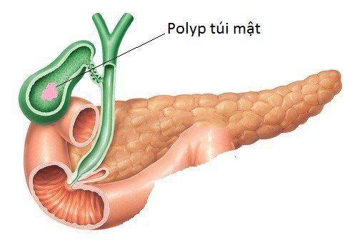 Gallbladder polyp