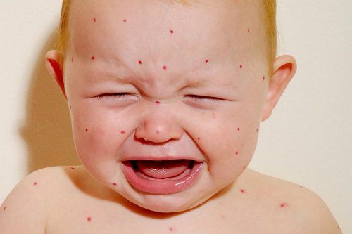 It is crucial to monitor for severe signs of the disease.