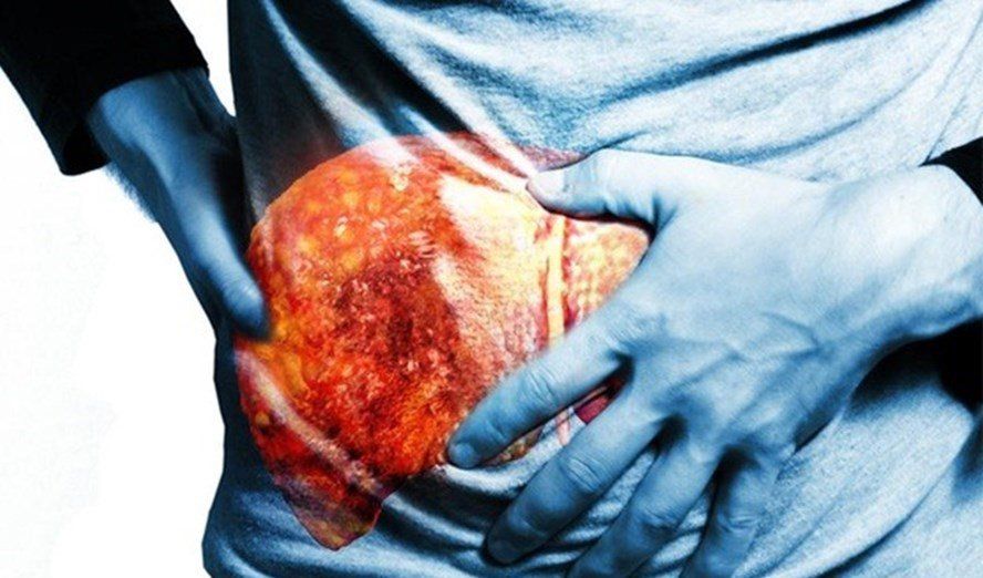 Độ xơ hóa gan F0 F1 là gì? – Giải mã 5 giai đoạn của xơ hóa gan 1 Độ xơ hóa gan F0 F1 là gì – Giải mã những giai đoạn ban đầu trong hành trình bảo vệ lá gan khỏe mạnh