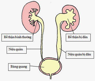 Siêu âm giãn đài bể thận là phương pháp chẩn đoán tình trạng bệnh lý hiệu quả