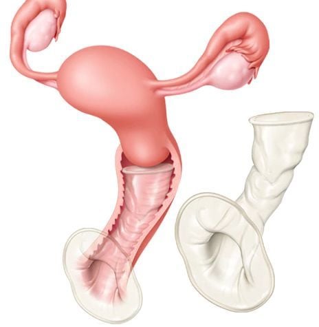 Female condom