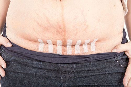 The Cesarean section incision requires thorough care.