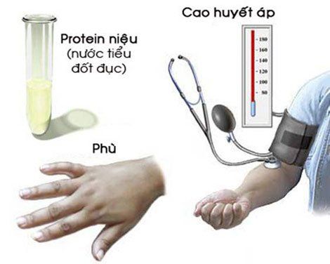 Các dấu hiệu chính của bệnh tiền sản giật