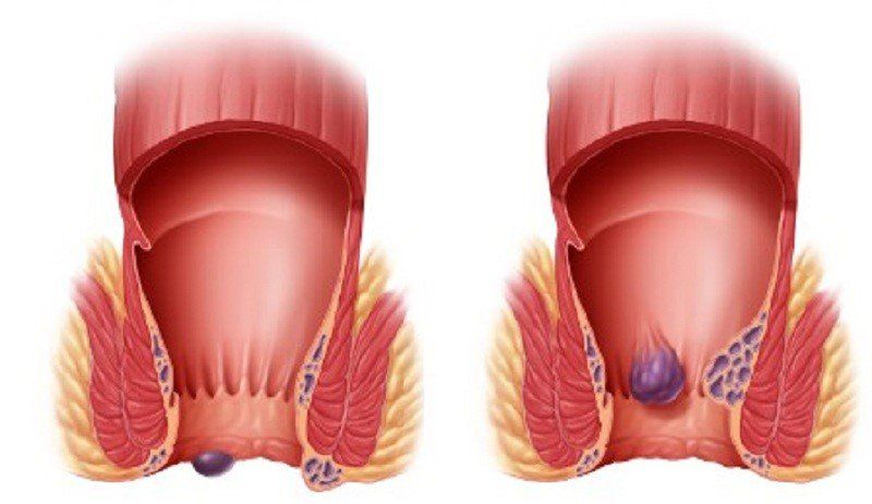 Khám bệnh trĩ: Quy trình khám và các phương pháp điều trị | Vinmec