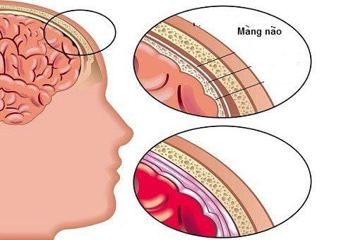 Hội chứng Williams - Beuren mắc chứng đái dầm
