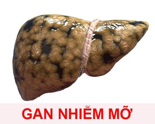 Gan nhiễm mỡ làm ảnh hưởng nghiêm trọng đến chức năng gan