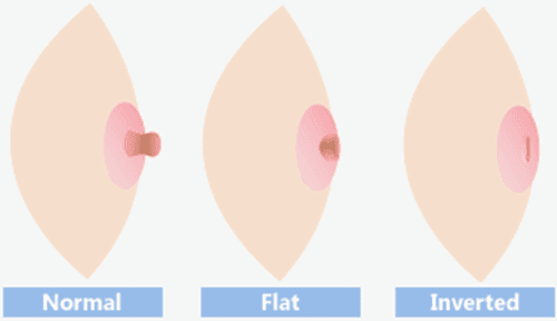 What to do if you have an inverted nipple?
