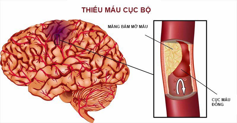 Sự hình thành cục máu đông trong não: Nguyên nhân hàng đầu gây đột quỵ |  Vinmec