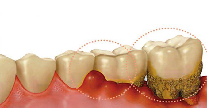 Các triệu chứng cảnh báo viêm lợi | Vinmec