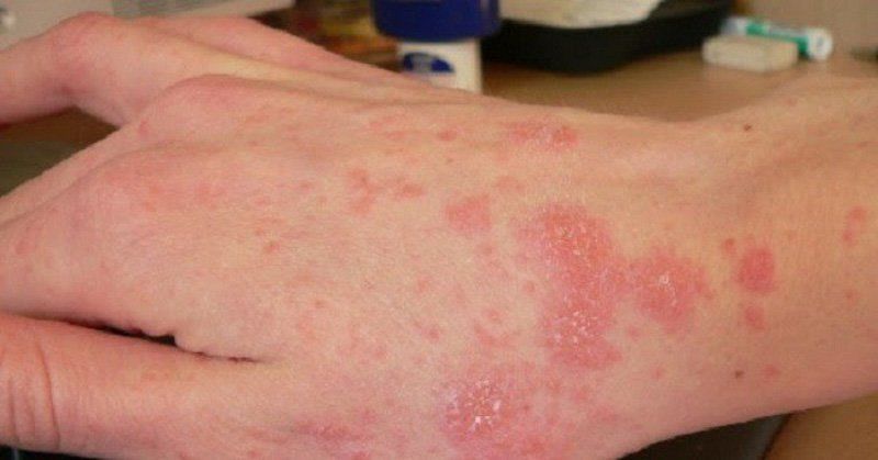 Các bệnh nấm da thường gặp | Vinmec