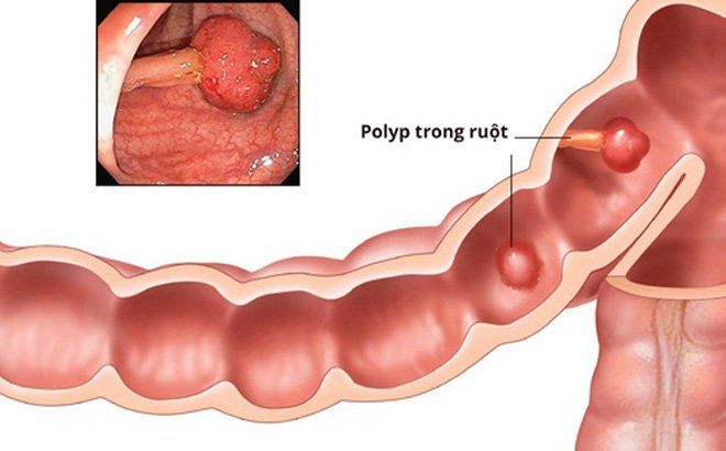 POLYP ĐẠI TRÀNG 10MM CẦN THEO DÕI SÁT ĐỂ ĐÁNH GIÁ MỨC ĐỘ NGUY HIỂM