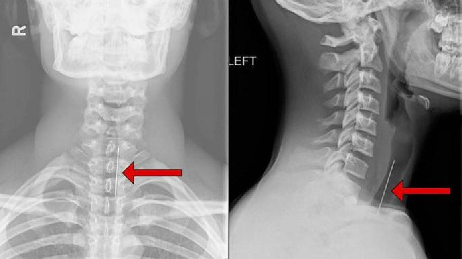 Learn the technique of Xray of the spine