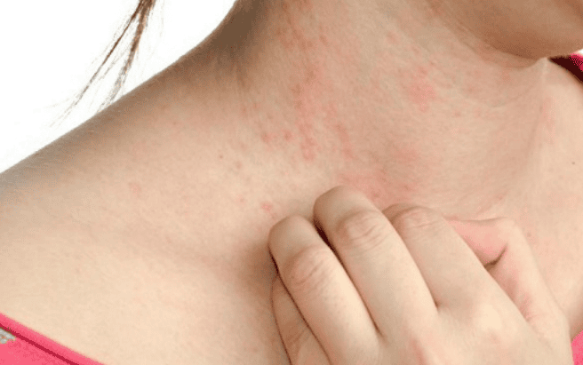 11 nguyên nhân phổ biến của phát ban da | Vinmec