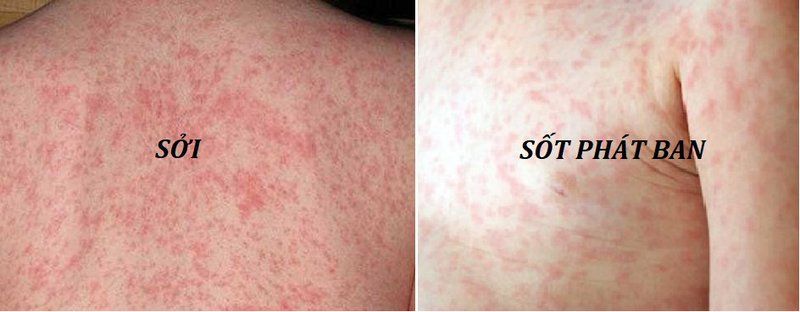 Sốt phát ban và sởi khác nhau như thế nào? | Vinmec