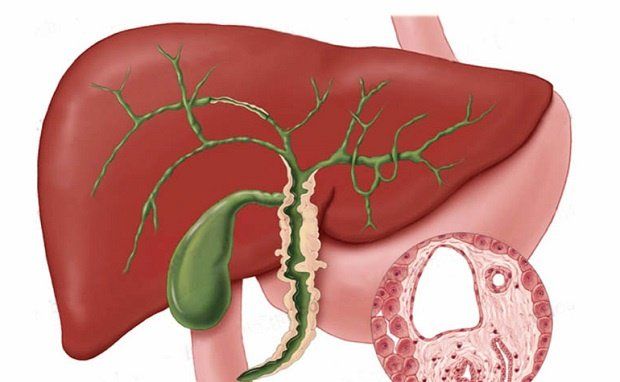 Tổn thương đường mật kéo dài có thể dẫn đến suy chức năng gan vĩnh viễn 