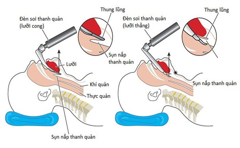 QUY TRÌNH ĐẶT NỘI KHÍ QUẢN THEO TIÊU CHUẨN