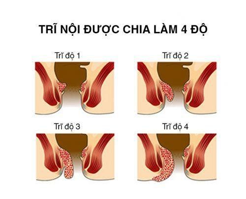Các mức độ trĩ nội.