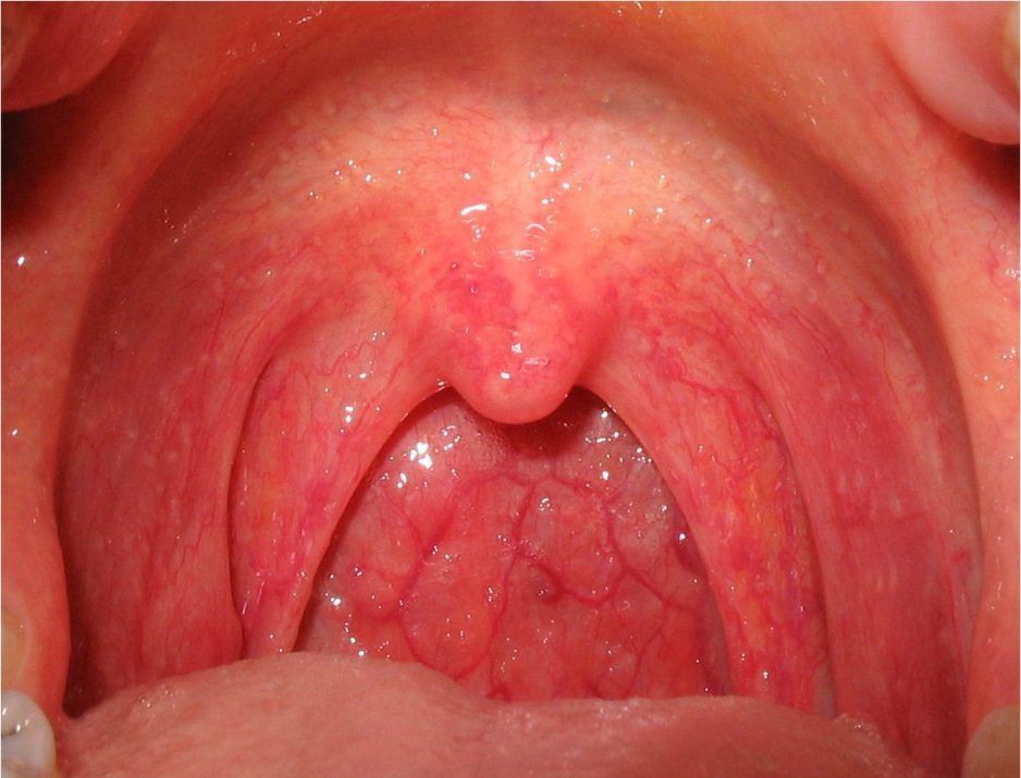 HÌNH ẢNH CỔ HỌNG BỊ VIÊM HẠT CHO THẤY CÁC CHẤM NHỎ NỔI RÕ PHÍA SAU