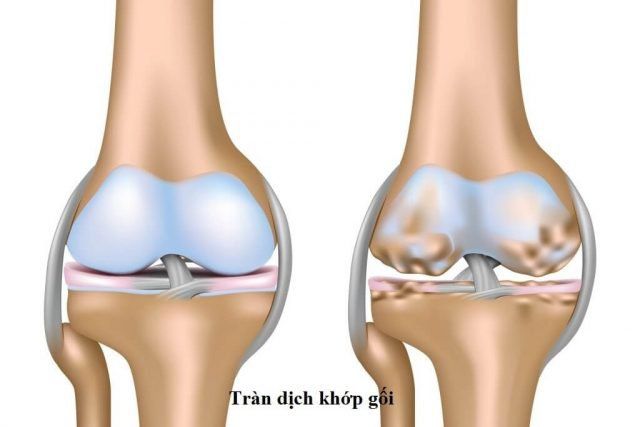 Tràn dịch khớp gối nên ăn gì và kiêng gì? | Vinmec