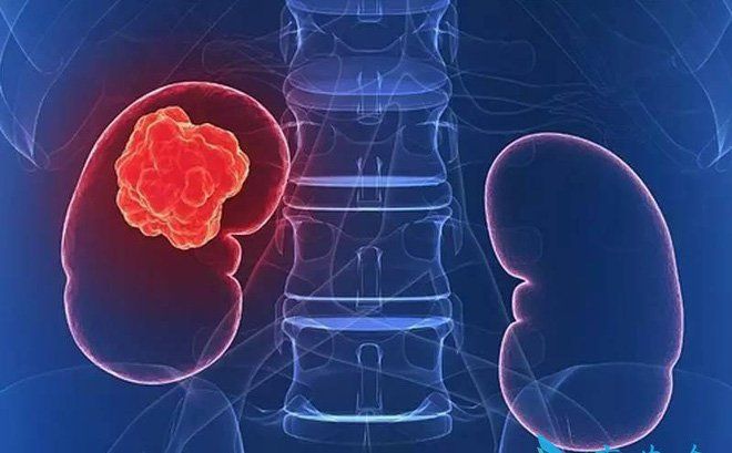 Triệu chứng bệnh thận mãn tính và dấu hiệu cảnh báo | Vinmec