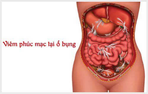 Phẫu thuật nội soi ổ bụng có thể được thực hiện khi bị viêm phúc mạc do thủng cơ quan nội tạng