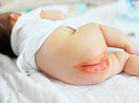 Change diapers regularly and keep the anal area clean