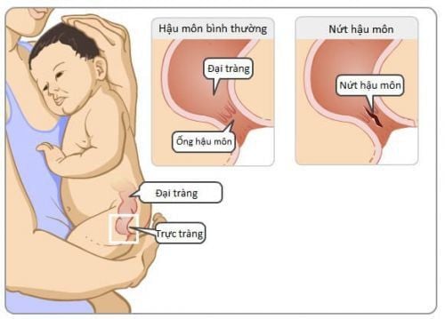 Up to 80% of children have anal fissures in the first year of life