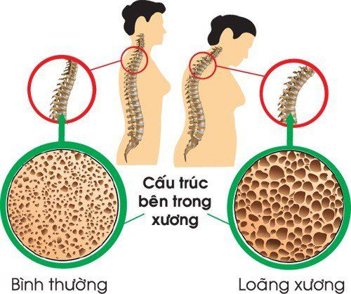 Tình trạng loãng xương