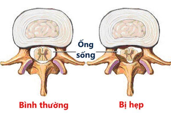 Hẹp ống sống: Khi nào cần phẫu thuật? | Vinmec